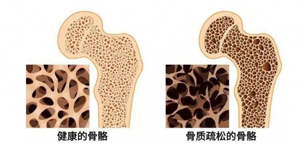 还在“盲目”防晒?小心骨头“偷偷”变脆 还在“盲目”防晒?小心骨头“偷偷”变脆